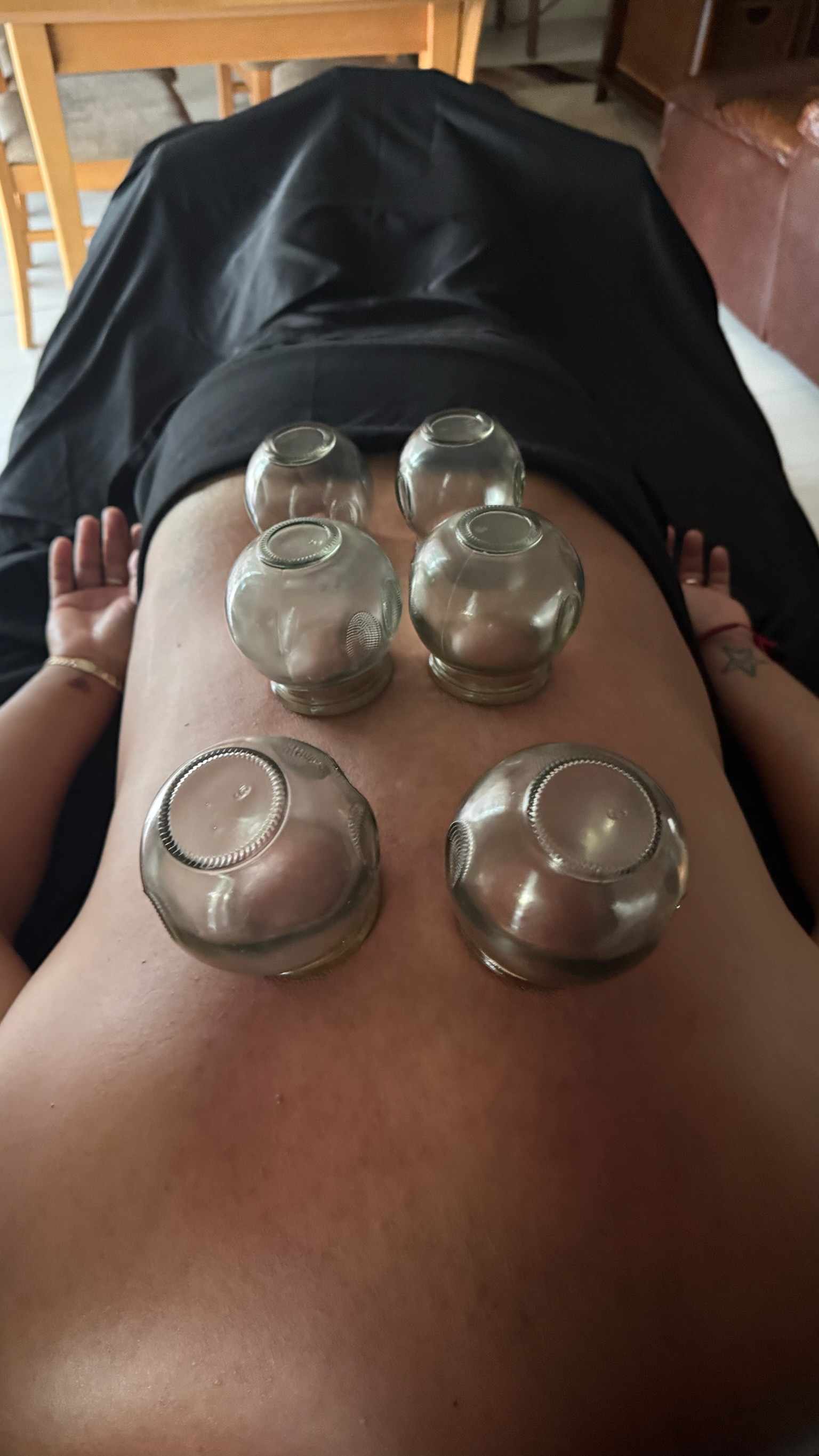 Cupping therapy